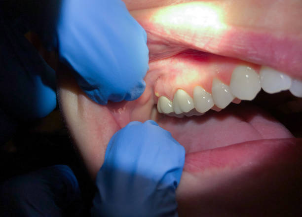 Best Knocked-Out Tooth Emergency  in Lake Brownwood, TX